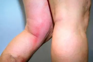 arterial color doppler lower and upper limbs