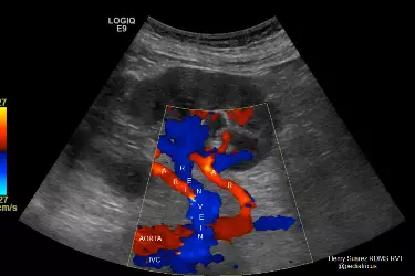 renal artery color doppler test